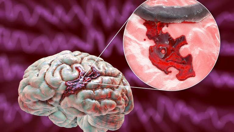 Graphische Darstellung eines hämorrhagischen Schlaganfalls. Blutungen in den Hirngefäßen können einen Schlaganfall auslösen. Beim Patienten äußern sich dann typische Symptome.