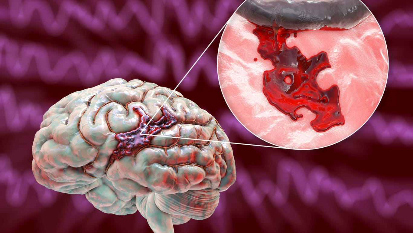 Graphische Darstellung eines hämorrhagischen Schlaganfalls. Blutungen in den Hirngefäßen können einen Schlaganfall auslösen. Beim Patienten äußern sich dann typische Symptome.