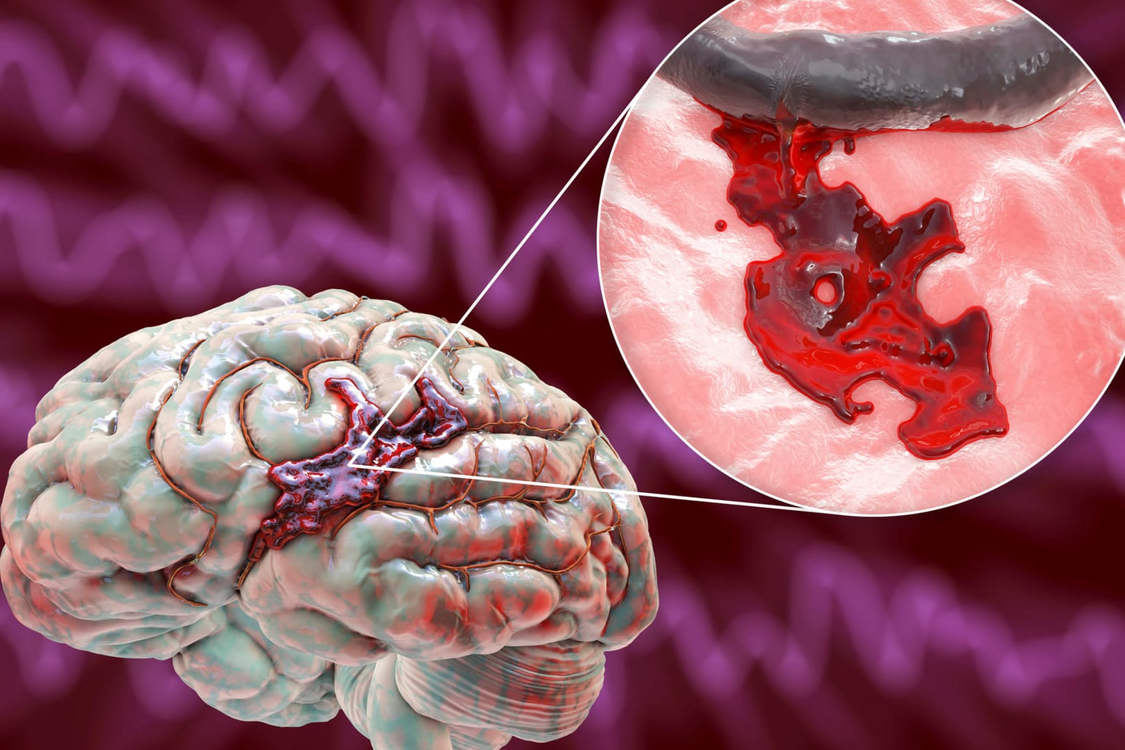 Graphische Darstellung eines hämorrhagischen Schlaganfalls. Blutungen in den Hirngefäßen können einen Schlaganfall auslösen. Beim Patienten äußern sich dann typische Symptome.