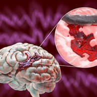 Graphische Darstellung eines hämorrhagischen Schlaganfalls. Blutungen in den Hirngefäßen können einen Schlaganfall auslösen. Beim Patienten äußern sich dann typische Symptome.