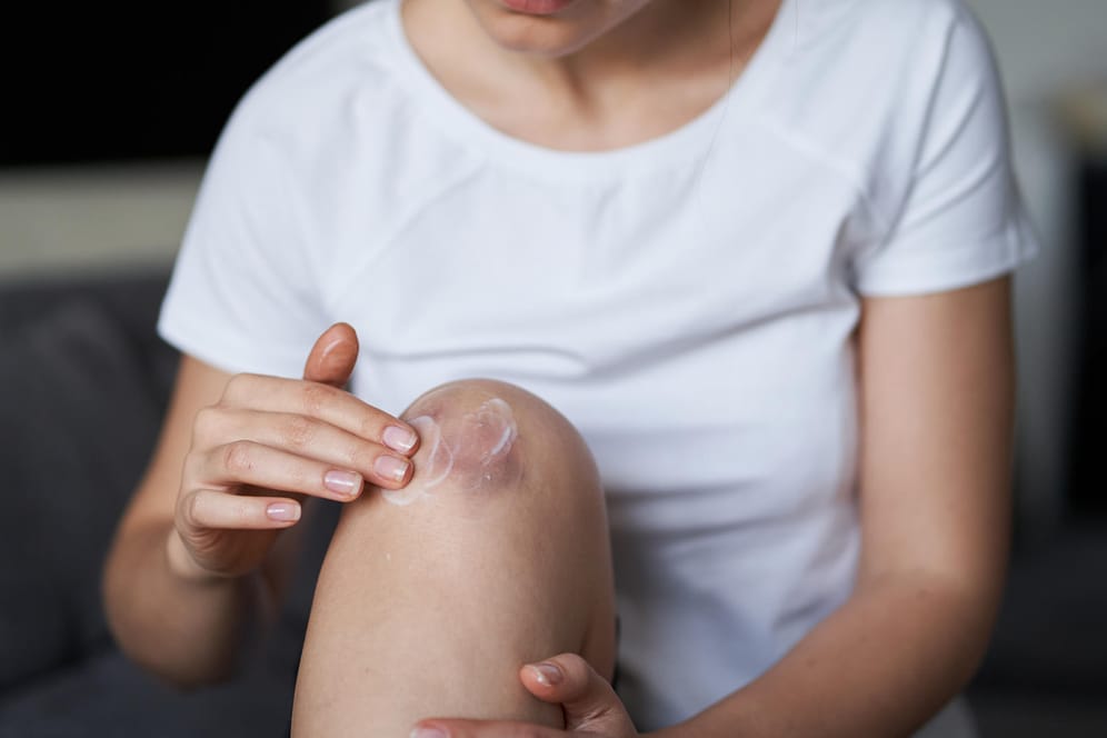 Eine Frau salbt sich einen blauen Fleck am Knie ein.