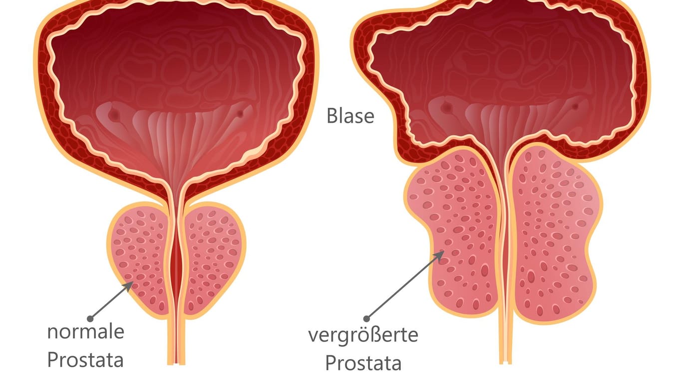 Darstellung von Harnblase und Prostata