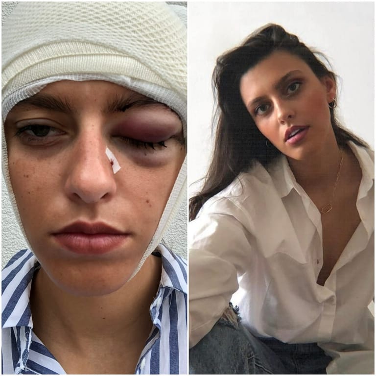 Das verletzte Gesicht des Models: Mit dem Facebook-Posting habe sie den Druck auf den Täter erhöhen wollen.