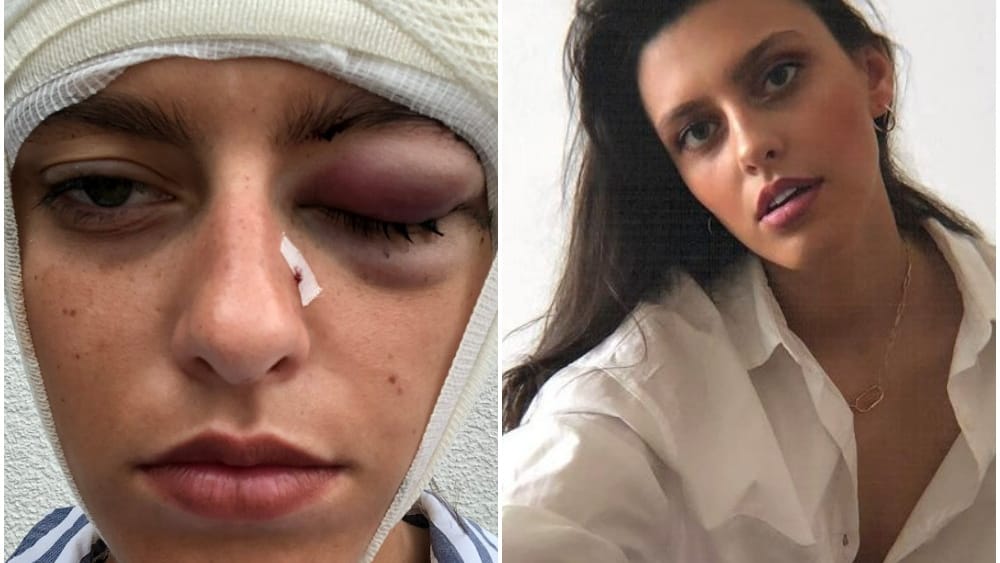Das verletzte Gesicht des Models: Mit dem Facebook-Posting habe sie den Druck auf den Täter erhöhen wollen. Das verletzte Gesicht des Models: Mit dem Facebook-Posting habe sie den Druck auf den Täter erhöhen wollen.