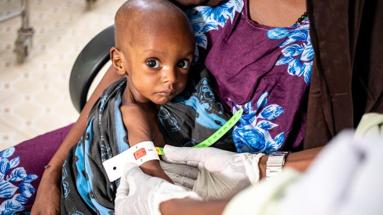 Der einjährige Salman Issak in der somalischen Hauptstadt Mogadischu leidet an akuter Mangelernährung.