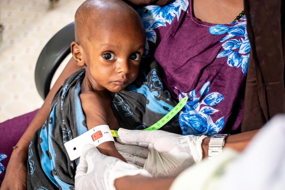 Der einjährige Salman Issak in der somalischen Hauptstadt Mogadischu leidet an akuter Mangelernährung.