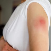 Impfreaktion am Oberarm einer Frau.