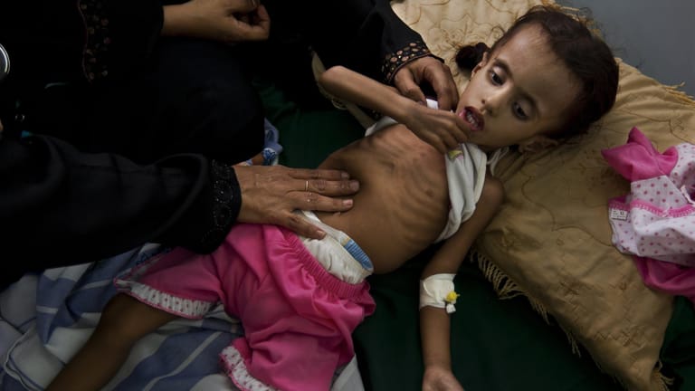 Unterernährtes Kind: Im Jemen hungern jetzt schon Millionen Menschen, der steigende Weizenpreis droht, die Lage in eine schwere Hungerskatastrophe zu entwickeln.