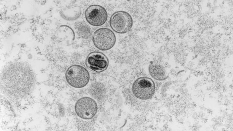 Affenpockenviren unter einem Mikroskop: In den USA gibt es auch einen Fall der seltenen Infektion.