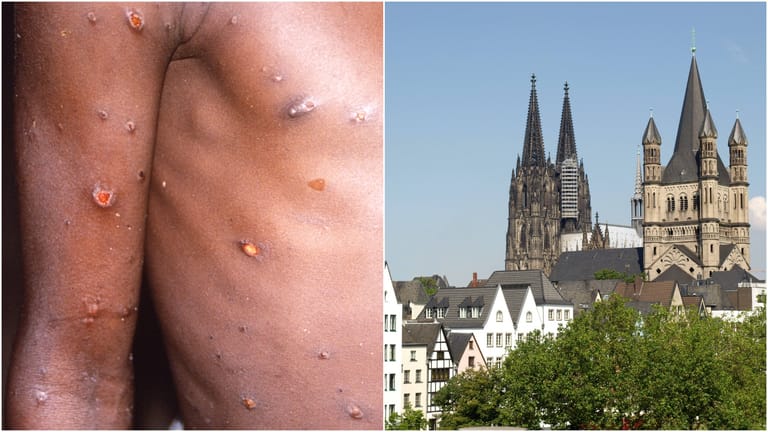 Affenpocken-Erkrankter und Kölner Dom (Montage): Laut einem Bericht hat ein Mann die "typischen Symptome".