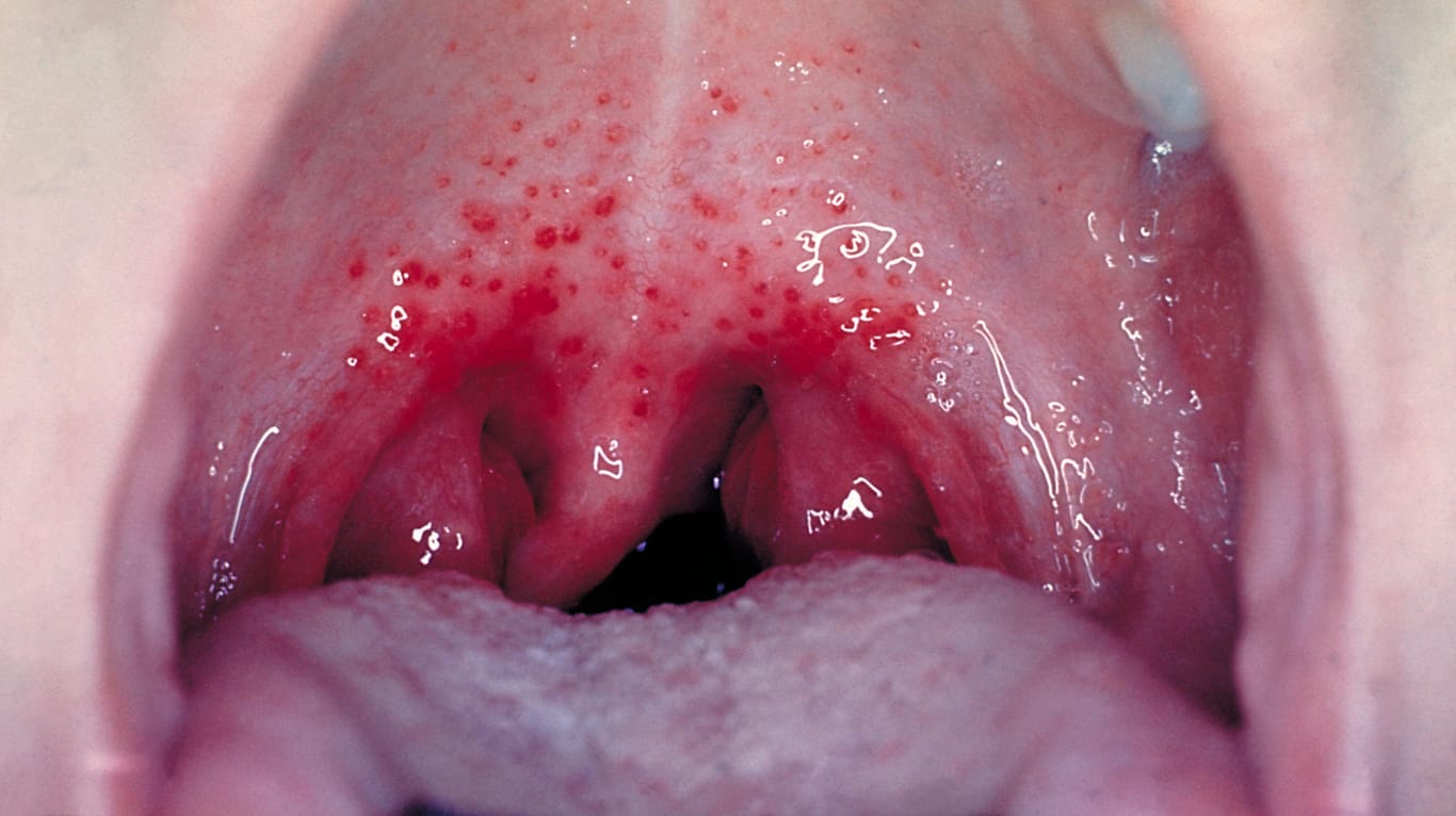 Petechien am Gaumen können im Rahmen verschiedener Infekte auftreten. In diesem Fall sind die punktförmigen Hauteinblutungen Begleiterscheinung einer Streptokokken-Infektion.