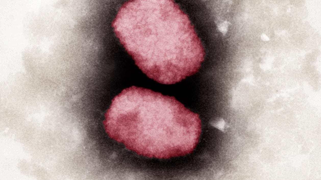 Affenpocken: Erste Symptome sind laut RKI Fieber, Kopf-, Muskel- und Rückenschmerzen sowie geschwollene Lymphknoten