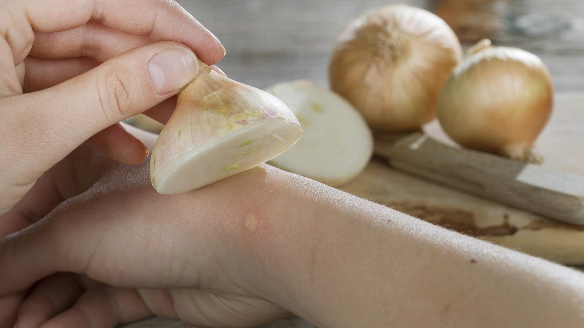 Auch Zwiebeln werden gerne zur Behandlung von Insektenstichen verwendet. Dazu entweder den Saft der Zwiebel auf die Wunde tröpfeln oder den Stich ein paar Minuten mit einer Zwiebelhälfte einreiben. Das hat eine desinfizierende und kühlende Wirkung.