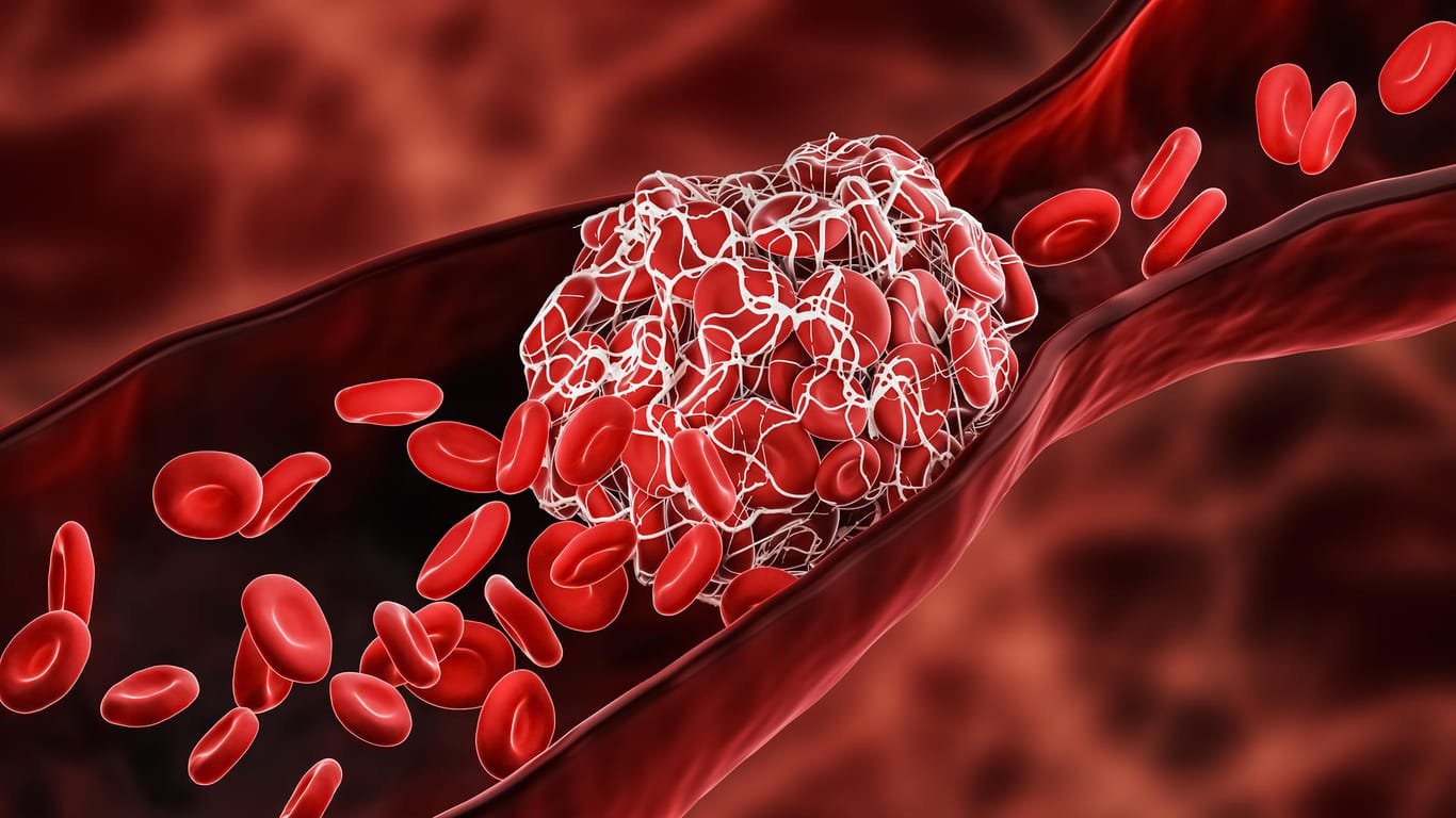Abbildung eines Blutgefäßes mit Gerinnsel (Symbolbild): Zu dickes Blut enthält eine über das Normalmaß hinaus hohe Konzentration an roten Blutkörperchen.