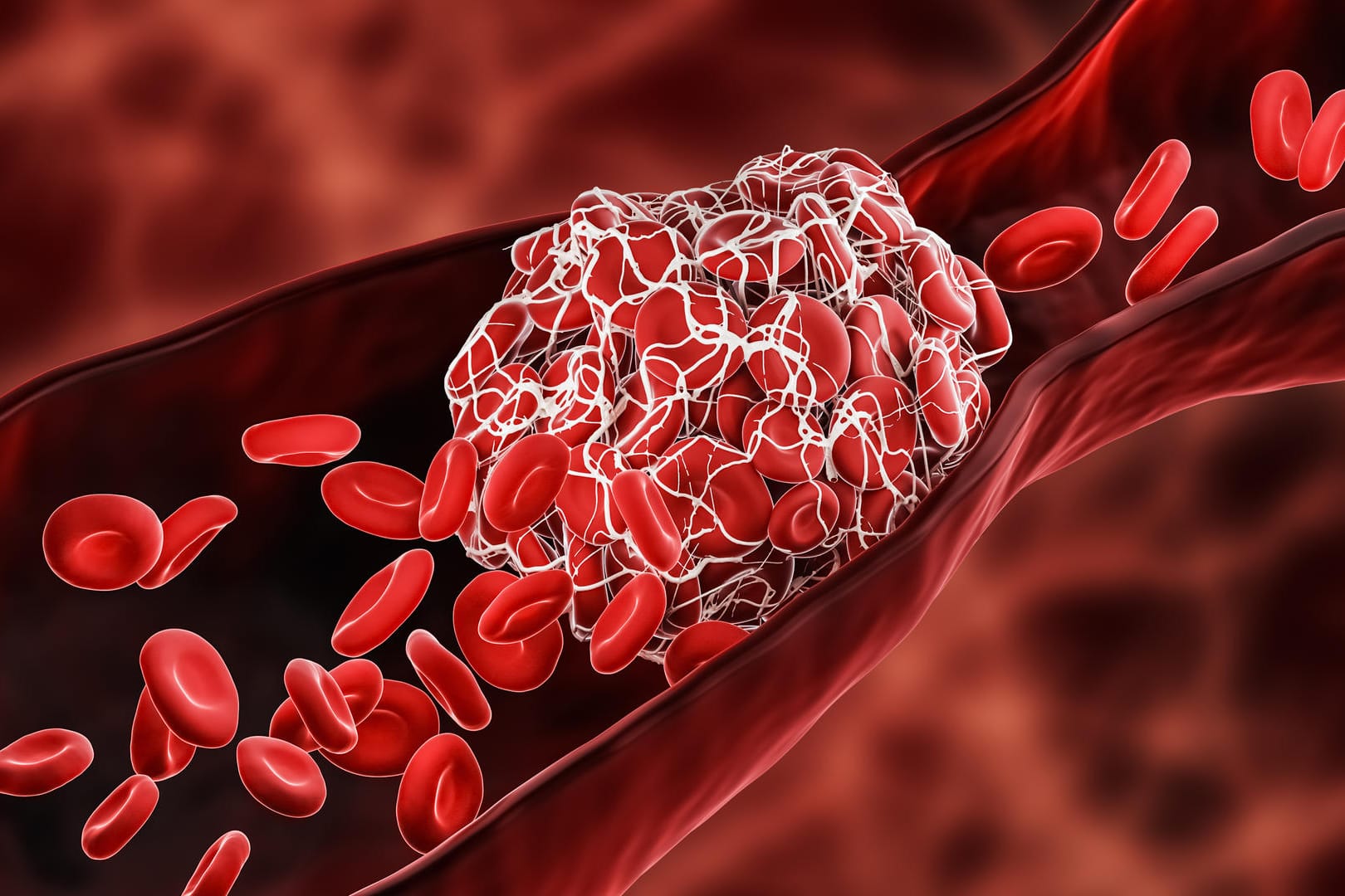 Abbildung eines Blutgefäßes mit Gerinnsel (Symbolbild): Zu dickes Blut enthält eine über das Normalmaß hinaus hohe Konzentration an roten Blutkörperchen.