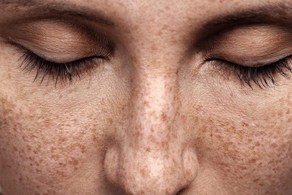 Sommersprossen: Viele stören sich an den dunklen Punkten im Gesicht oder am Körper.