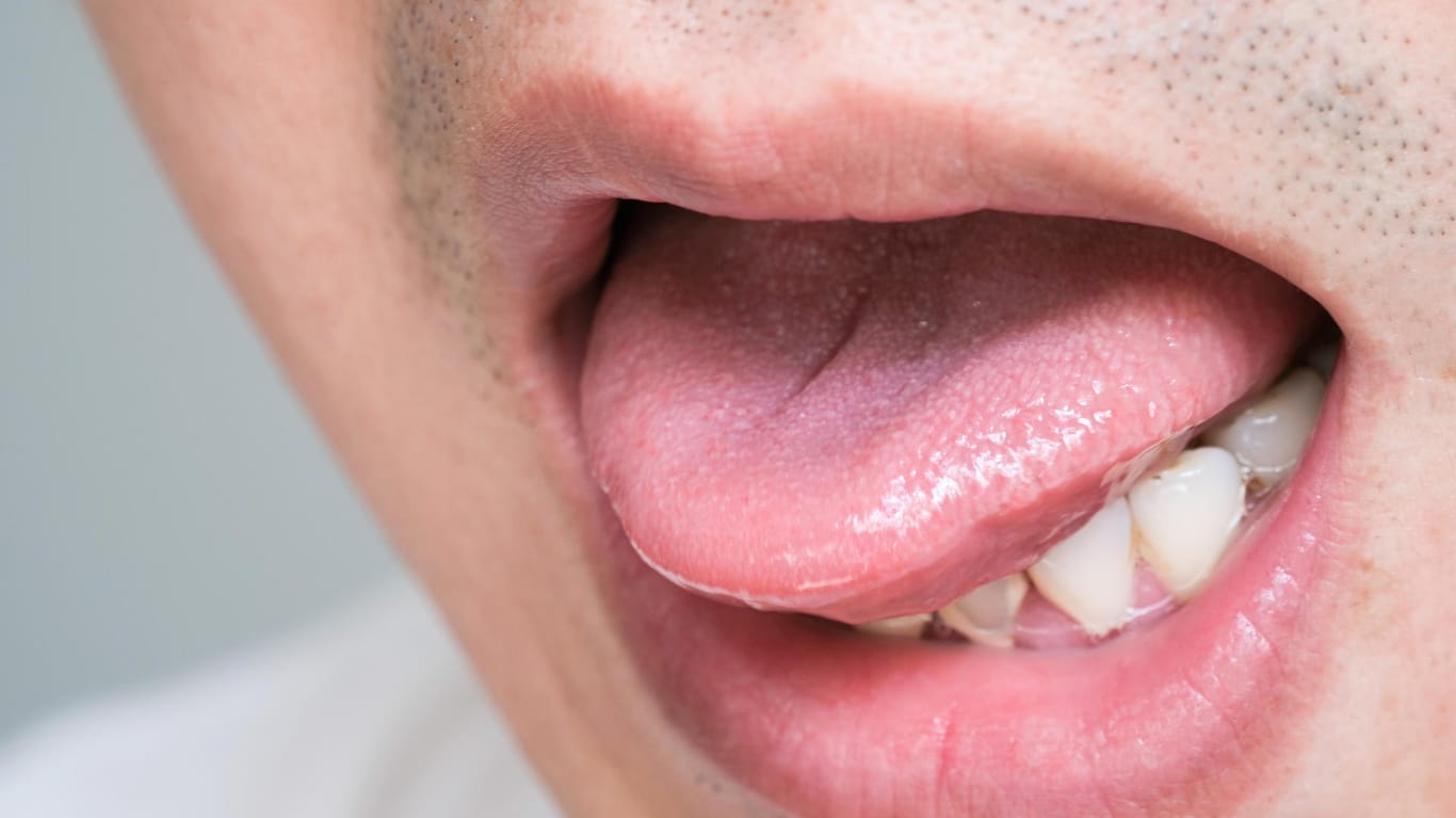 Burnt tongue (symbolic image): Burns in the mouth usually occur when hot drinks or food are consumed too quickly.