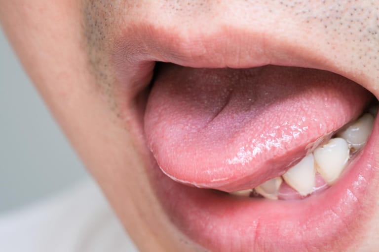 Zunge verbrannt (Symbolbild): Verbrennungen im Mund entstehen meist durch zu schnellen Verzehr von heißen Getränken oder Speisen.