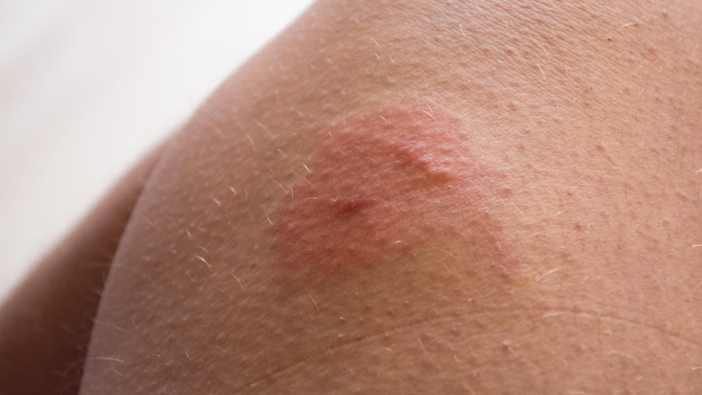 Insect bite: A horsefly sting can be quite painful.