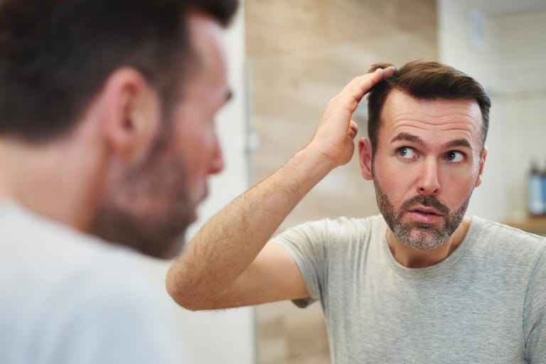 Geheimratsecken sind bei Männern oft die ersten Stellen, an denen sich Haarausfall zeigt.