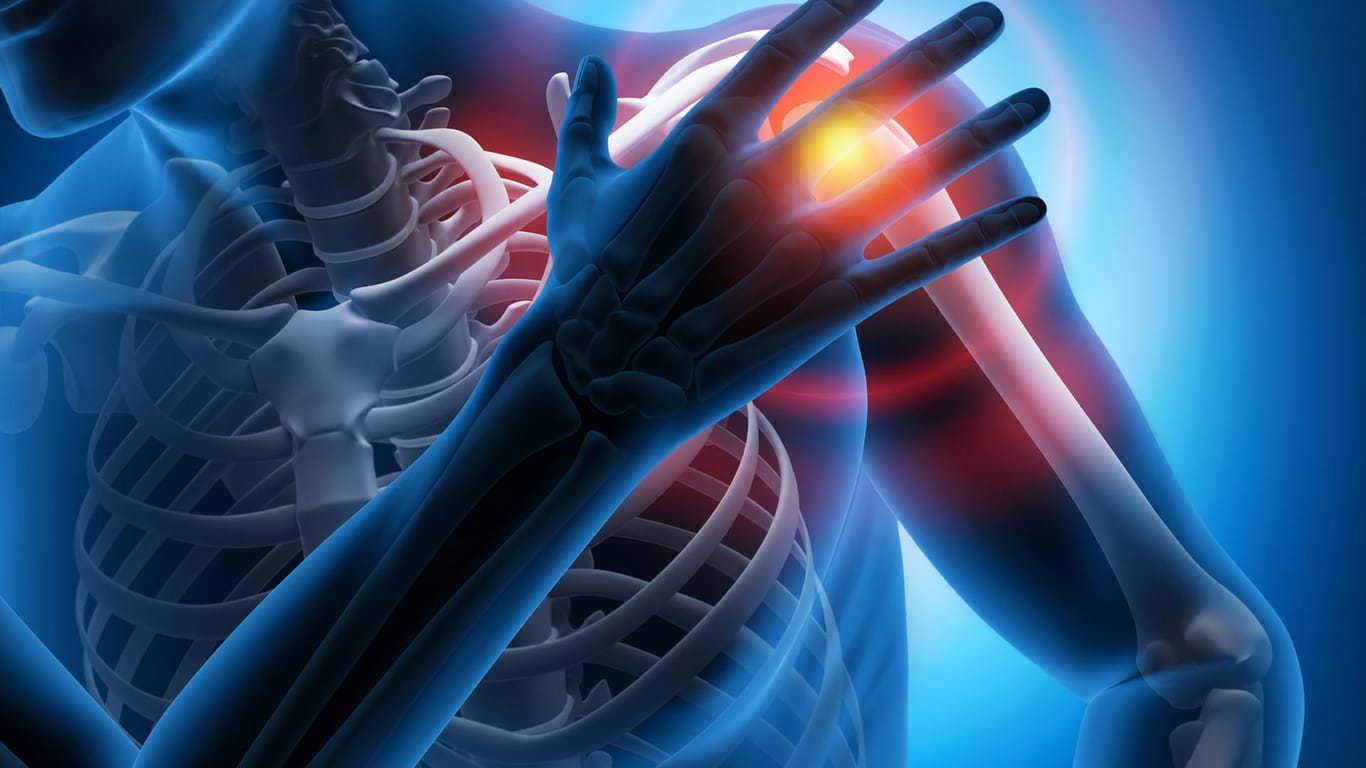 Schulterschmerz-Illustration: Beim Impingement-Syndrom treten beim seitlichen Heben oder bei Belastung starke Schulterschmerzen auf. Unbehandelt werden die Beschwerden zunehmend stärker und treten auch nachts auf.