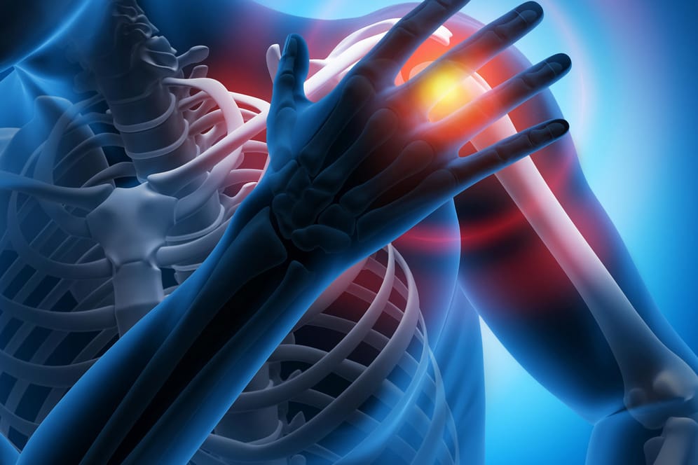 Schulterschmerz-Illustration: Beim Impingement-Syndrom treten beim seitlichen Heben oder bei Belastung starke Schulterschmerzen auf. Unbehandelt werden die Beschwerden zunehmend stärker und treten auch nachts auf.