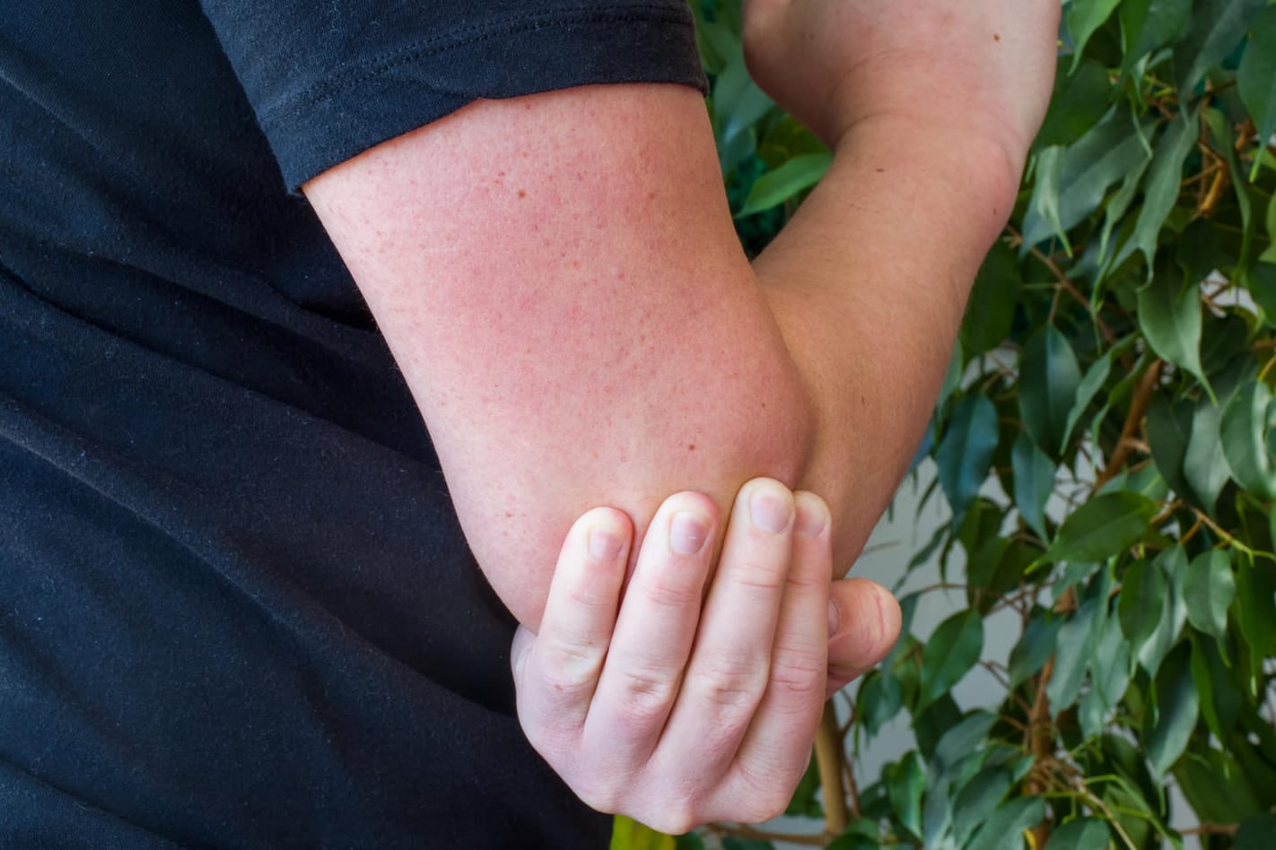 Muskelzucken im Arm (Symbolbild): Ein häufiger Auslöser ist Stress.