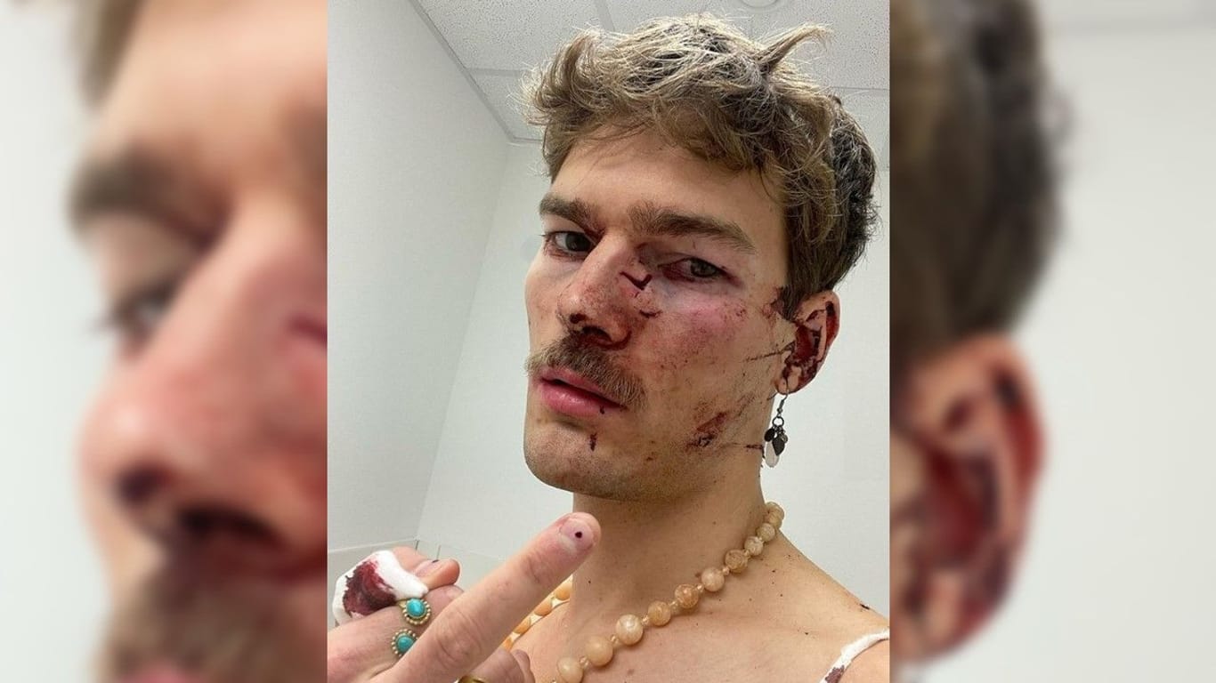 Lukas Wilmsmeyer im Krankenhaus: Der 27-Jährige wurde mit einer Flasche beworfen und musste wegen eines gebrochenen Nasenbeins und einer tiefen Schnittwunde behandelt werden.