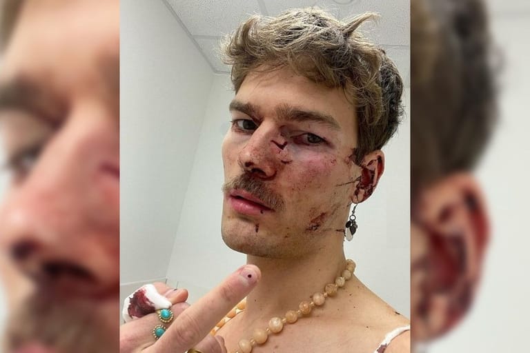 Lukas Wilmsmeyer im Krankenhaus: Der 27-Jährige wurde mit einer Flasche beworfen und musste wegen eines gebrochenen Nasenbeins und einer tiefen Schnittwunde behandelt werden.