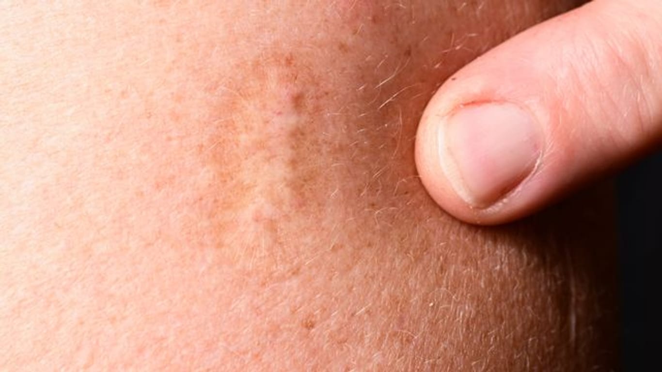 Vielen ältere Menschen haben noch eine solche Narbe von der Pockenimpfung am Oberarm.