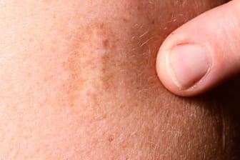 Vielen ältere Menschen haben noch eine solche Narbe von der Pockenimpfung am Oberarm.