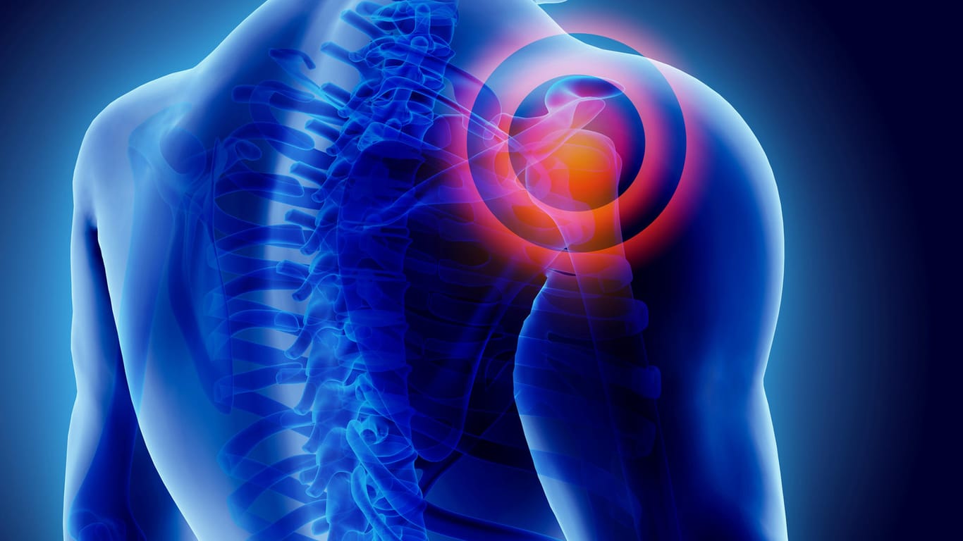 Illustration verletztes Schultergelenk: Die Kapsel des Schultergelenks ist am häufigsten von Entzündungen betroffen und kann dabei die Mobilität im Alltag stark einschränken.