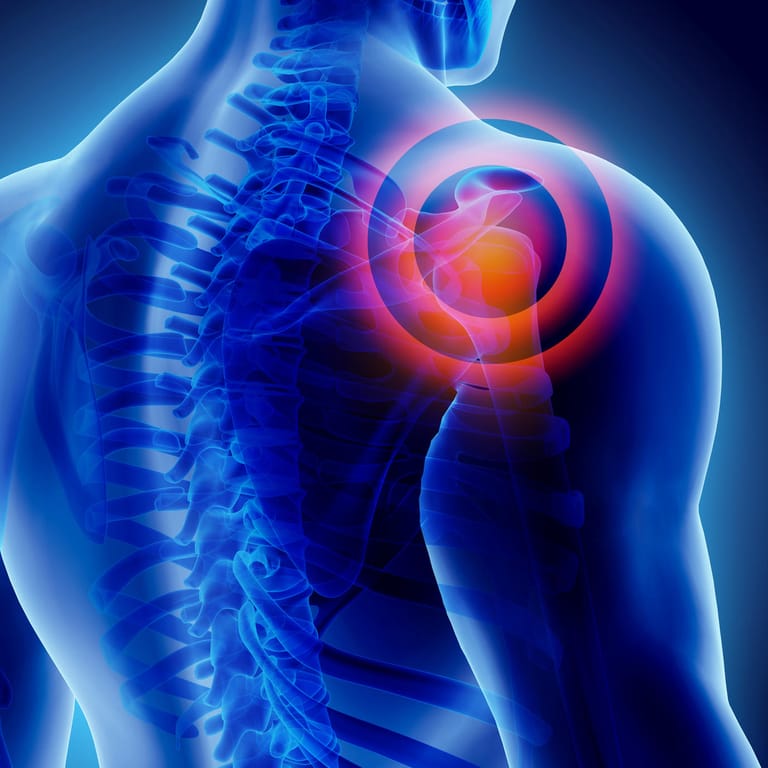 Illustration verletztes Schultergelenk: Die Kapsel des Schultergelenks ist am häufigsten von Entzündungen betroffen und kann dabei die Mobilität im Alltag stark einschränken.