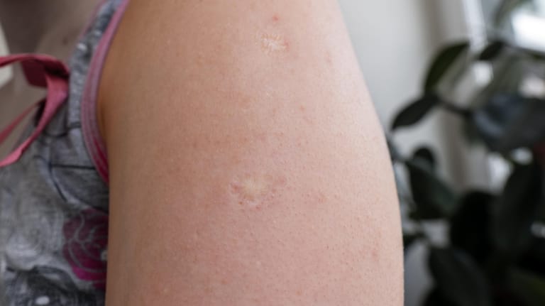 Oberarm mit zwei Narben infolge der Pockenimpfung
