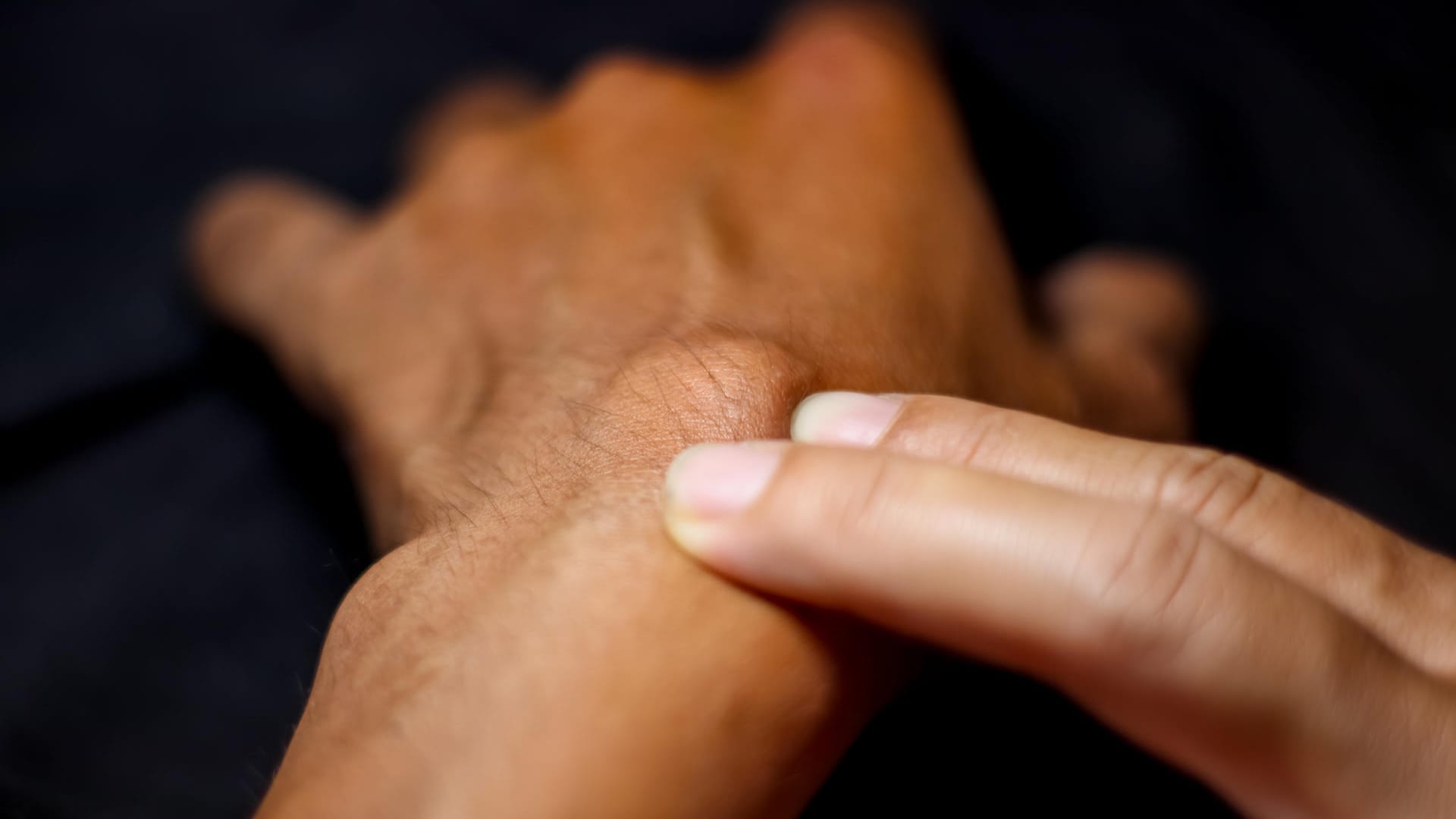 Ein Überbein am Handgelenk ist zwar optisch störend, aber immer gutartig. Es muss nur in seltenen Fällen chirurgisch entfernt werden.