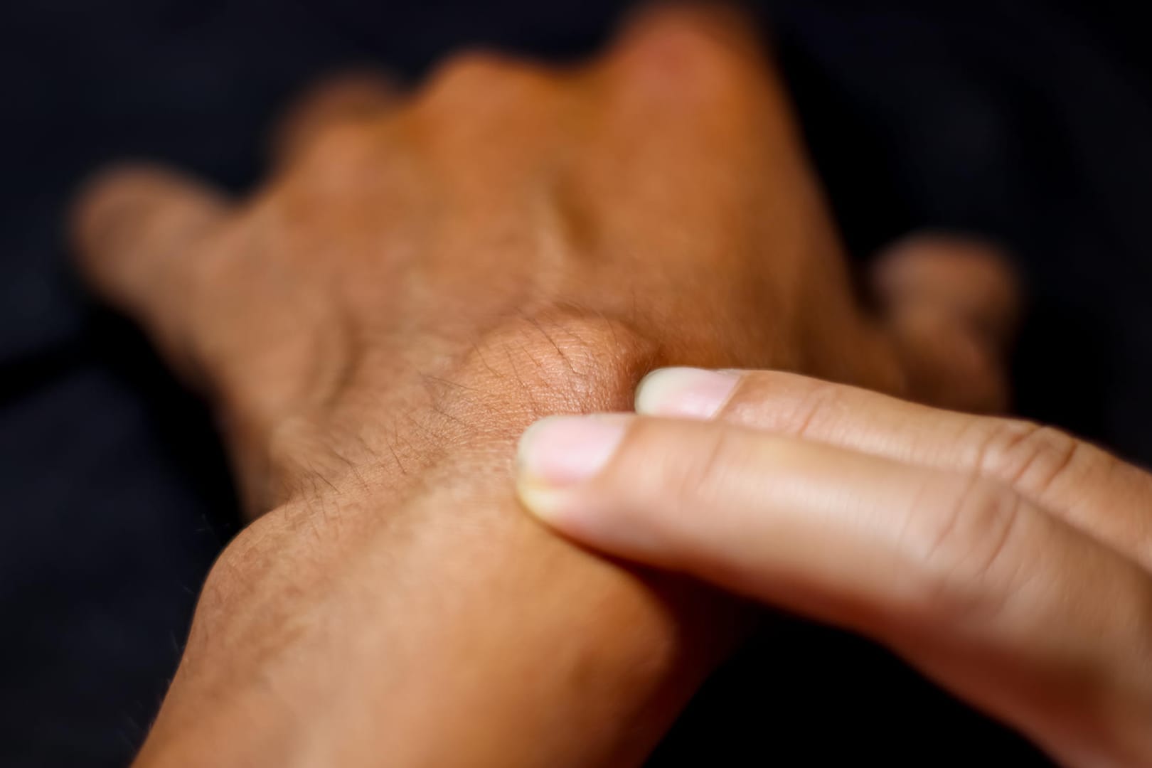 Ein Überbein am Handgelenk ist zwar optisch störend, aber immer gutartig. Es muss nur in seltenen Fällen chirurgisch entfernt werden.