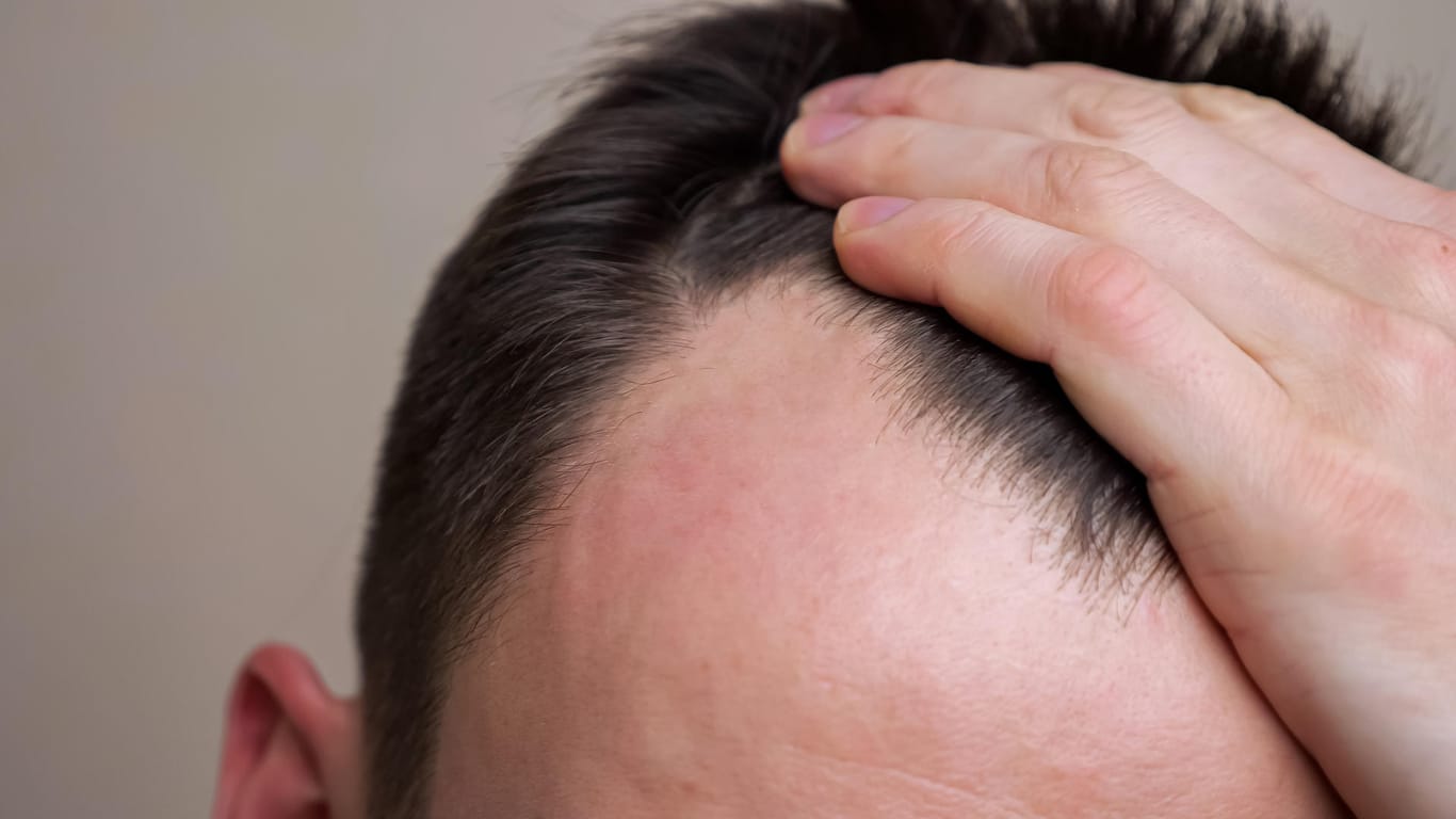 Für Männer kann Haarausfall sehr belastend sein. In den meisten Fällen ist er genetisch bedingt.