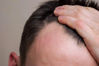 Für Männer kann Haarausfall sehr belastend sein. In den meisten Fällen ist er genetisch bedingt.