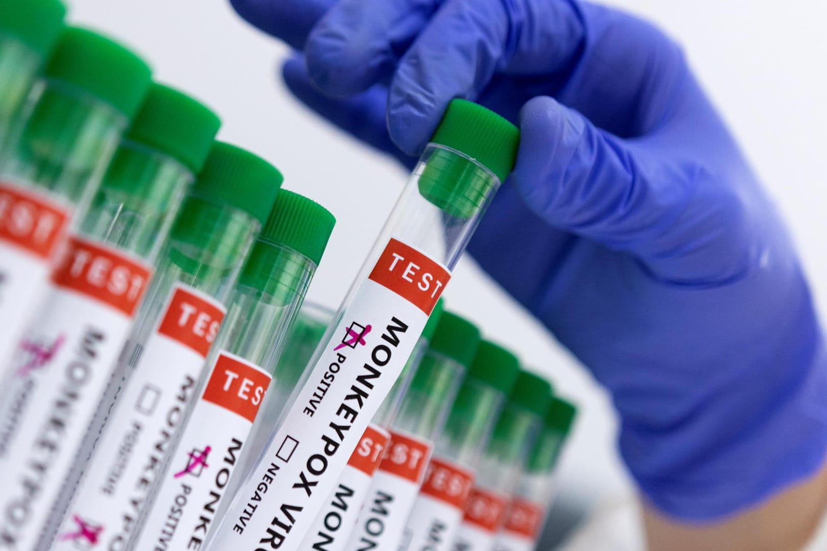 Tests auf Affenpocken (Symbolbild): Erstmals ist das Virus auch bei einem Kind nachgewiesen worden.