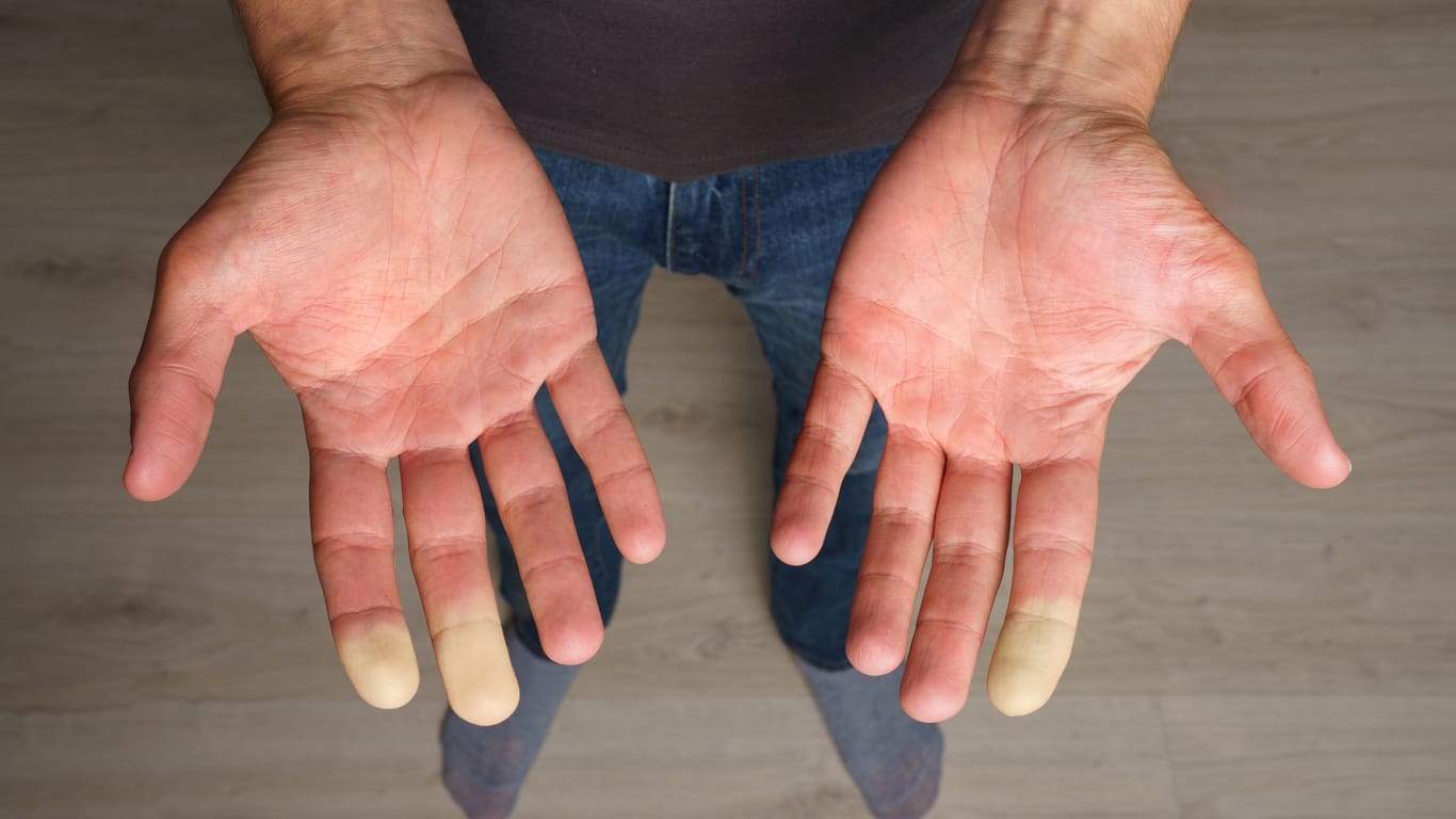 Beim Raynaud-Syndrom färben sich meist die Finger asymmetrisch weiß. Auch Zehen können betroffen sein.