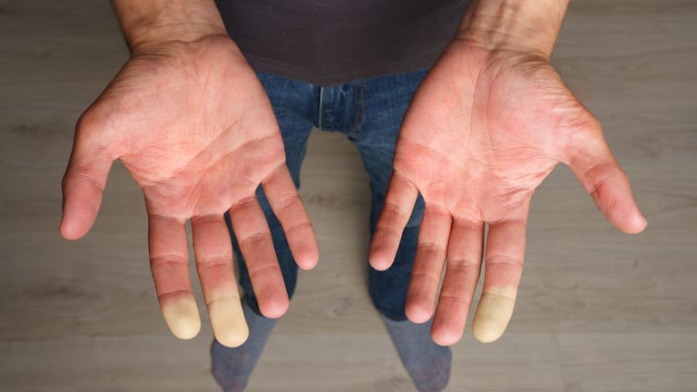 Beim sekundären Raynaud-Syndrom färben sich die Finger an den Händen häufig asymmetrisch weiß.