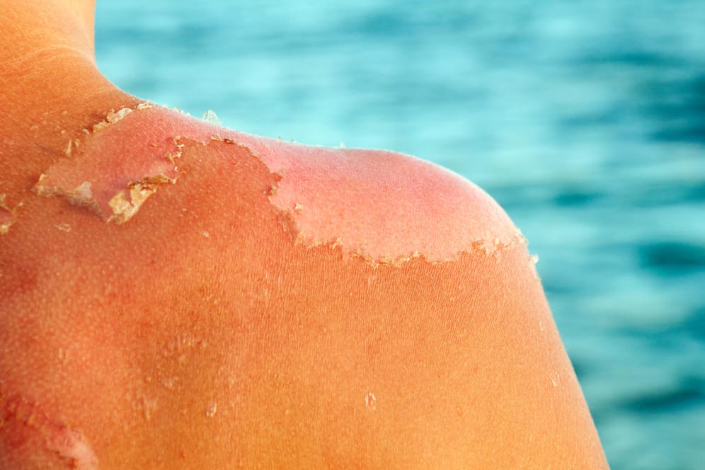 Schulter einer Frau mit Sonnenbrand; die Haut schält sich.