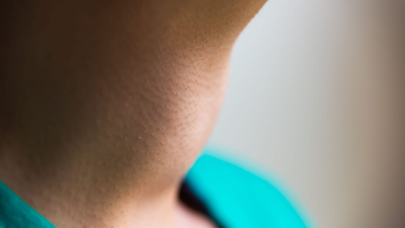 Jodmangel führt zum Wachstum der Schilddrüse. Die resultierende Schwellung am Hals wird als Struma oder Kropf bezeichnet.