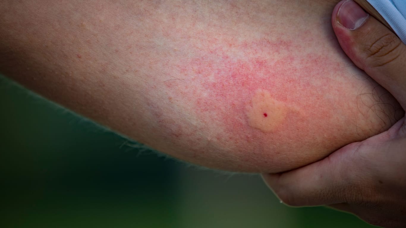 Manche Menschen reagieren mit starken Schwellungen und Juckreiz auf Mückenstiche.