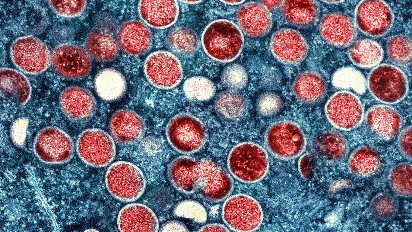 Affenpockenvirus unter dem Mikroskop (Symbolbild): Mehr als 2.700 Menschen haben sich in Deutschland bereits infiziert.