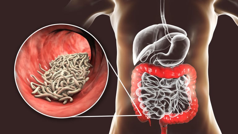 Illustration: Madenwürmer (Enterobius vermicularis) im Darm
