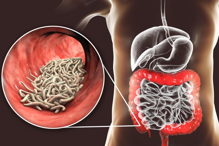 Illustration: Madenwürmer (Enterobius vermicularis) im Darm