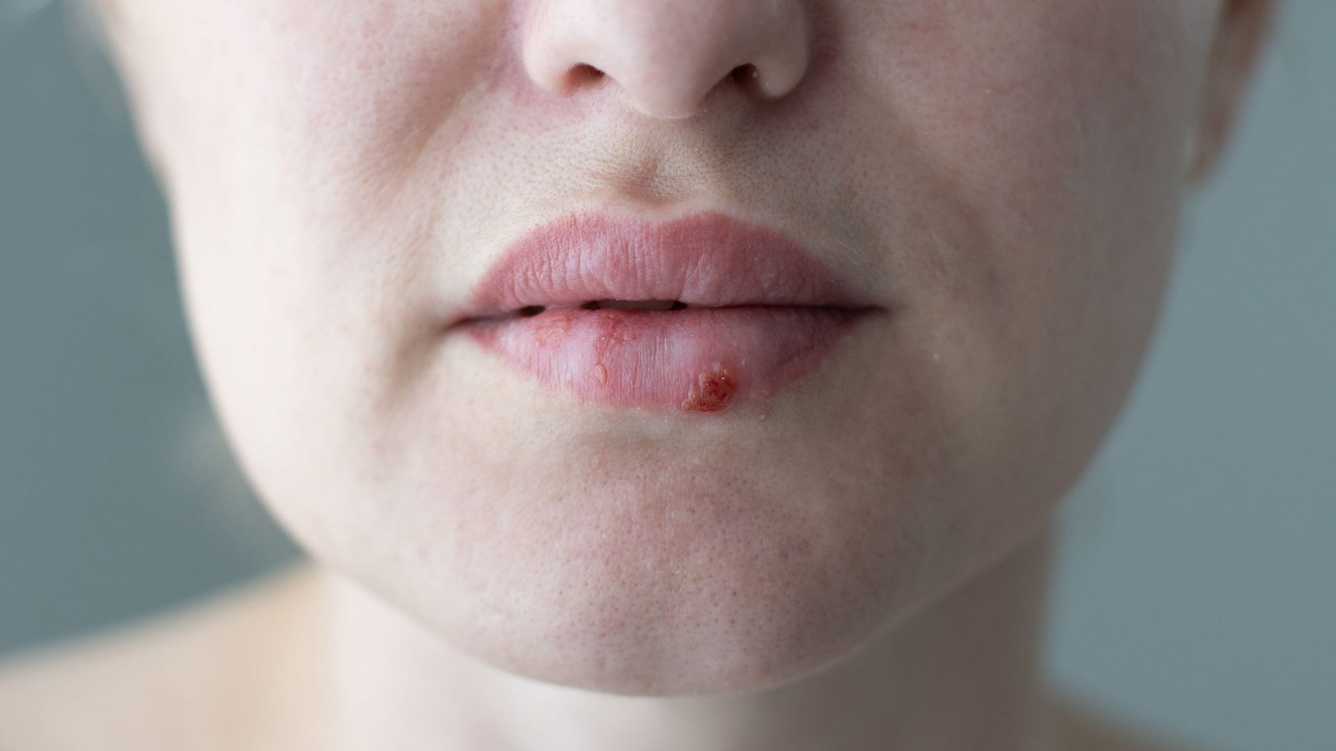 Frau mit Lippenherpes