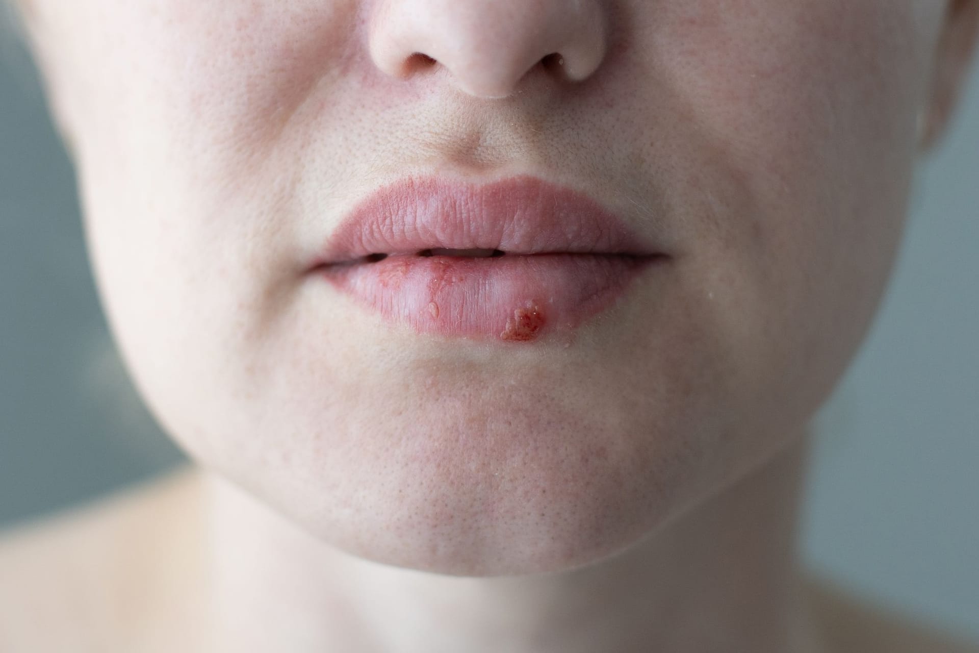 Frau mit Lippenherpes