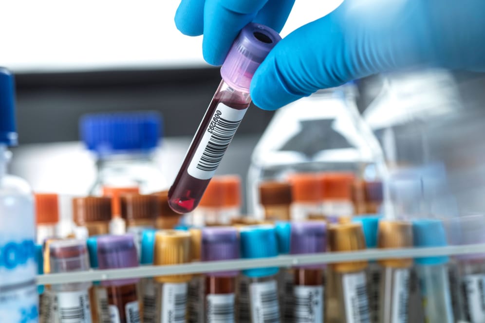 Blutproben: Ein neuer Test erkennt die Tumor-DNA und wo der Tumor im Körper sitzt.